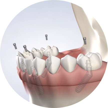 full arch dental implants in aliso viejo, CA
