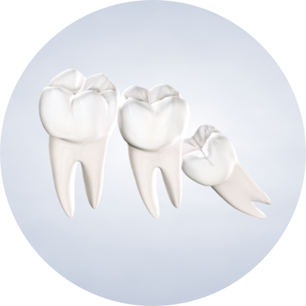 Wisdom teeth removal in aliso viejo, CA